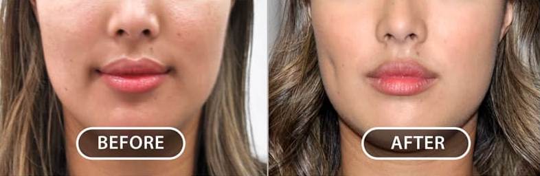 dimple surgery before and after